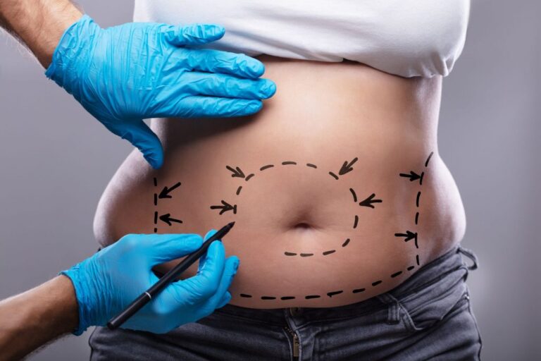 Combien coûte chirurgie abdominoplastie circulaire Tunisie : Guide des Prix et Options