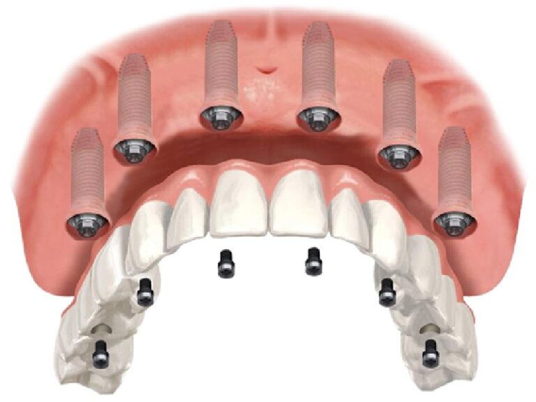 Soins dentaires par pose implant all on 6 en Tunisie : Solution complète pour un sourire parfait