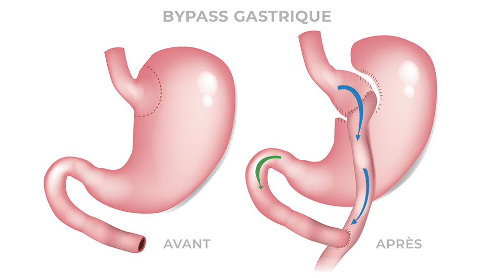 dilatation-estomac-bypass-1