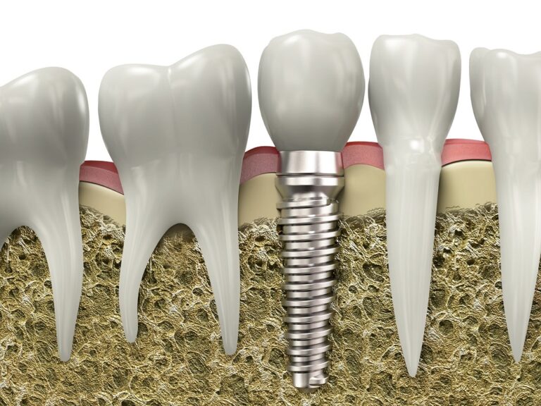 Les prix d’un implant dentaire en France et à l’international : comparaison et analyse