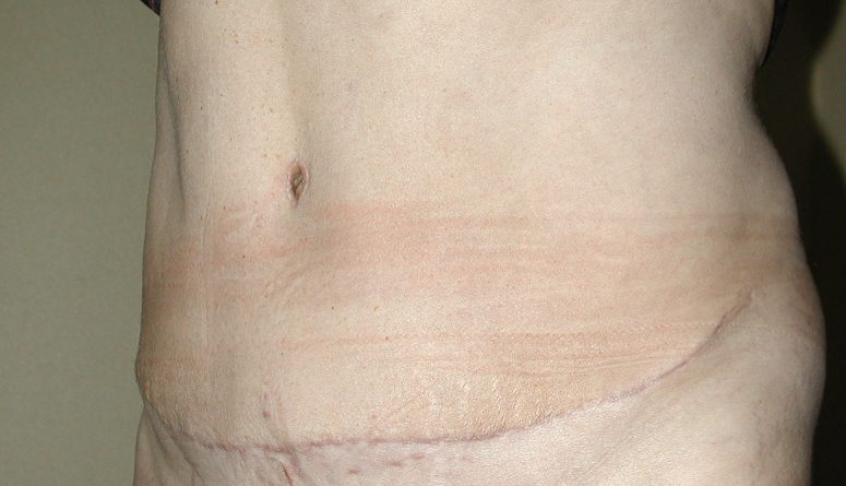 cicatrice-abdominoplastie-1-an