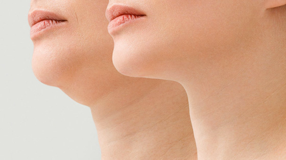 Lifting cou et liposuccion cou : meilleur association de chirurgie esthétique, prix en France